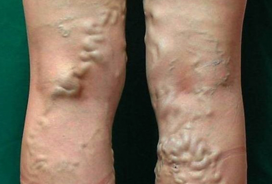 하지정맥류의 모습