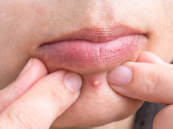 스티바에이크림 효과