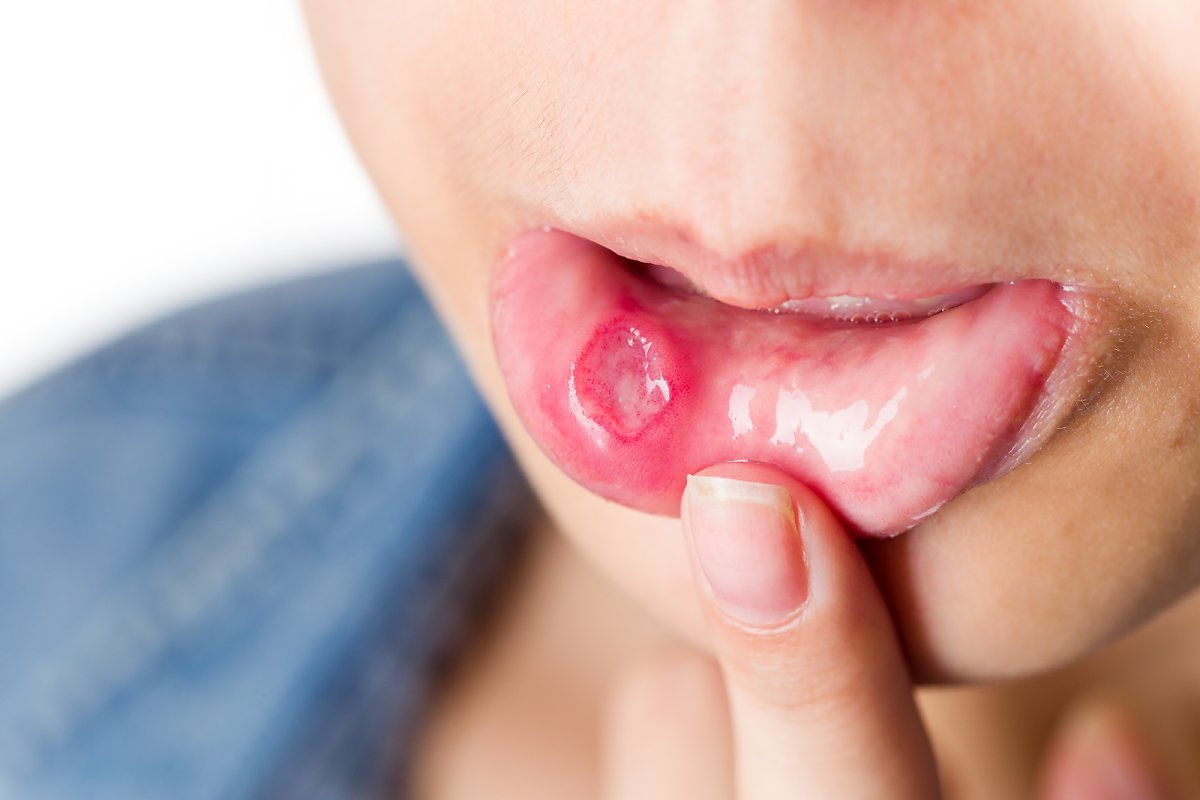 혀 통증 원인 혓바늘이 돋는 이유 혀 끝&amp;#44; 옆&amp;#44; 밑&amp;#44; 안쪽&amp;#44; 뿌리