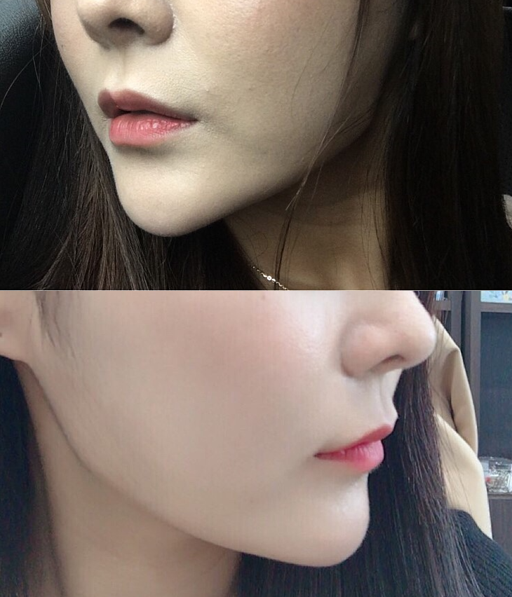 입술확대수술