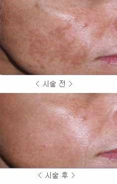 프락셀 시술전후