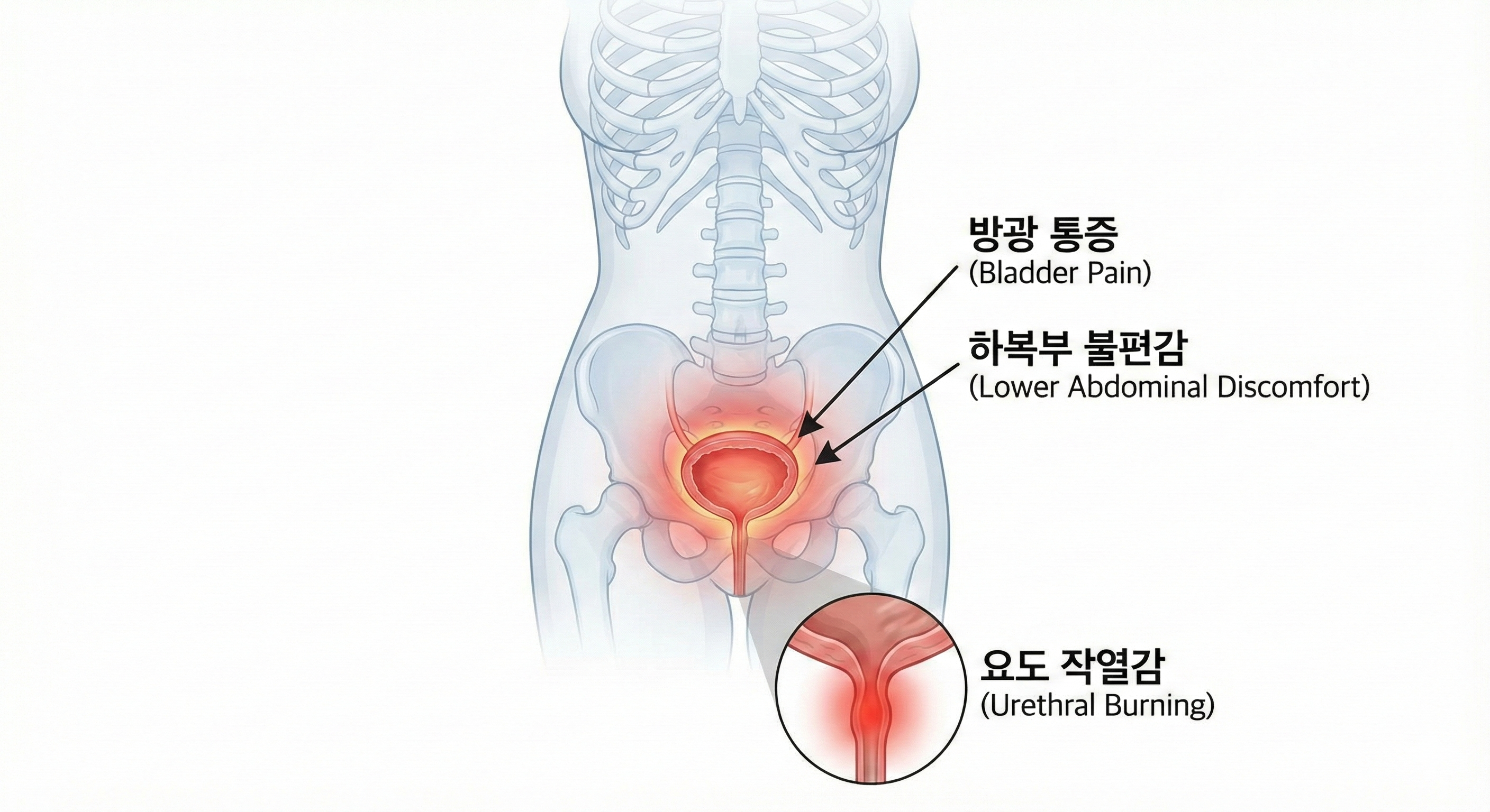 방광염 증상 부위