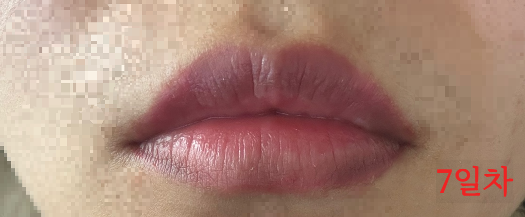 립타투 7일차 정면 – 붓기 완화 및 자연스러워진 색감