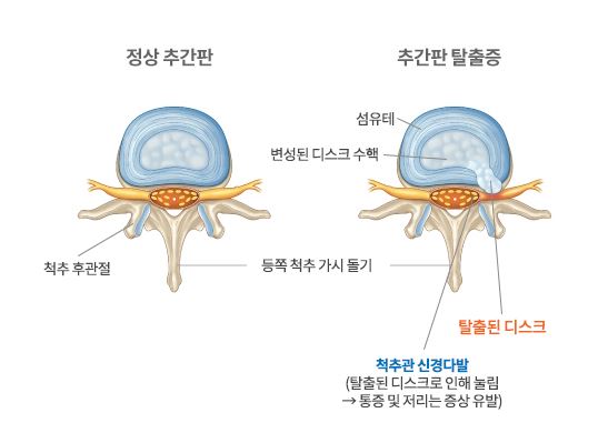 허리-디스크-돌출증