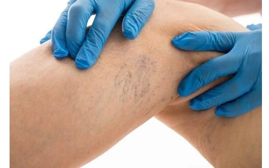 보라색 또는 파란색 정맥색이 보이는 하지정맥류 증상