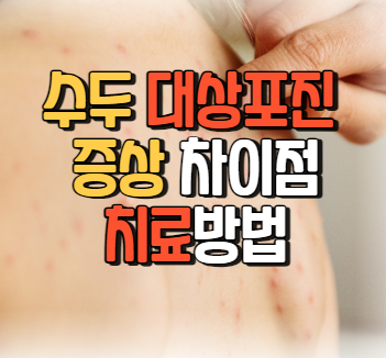 수두 대상포진