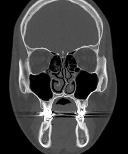 비중격 만곡의 진단