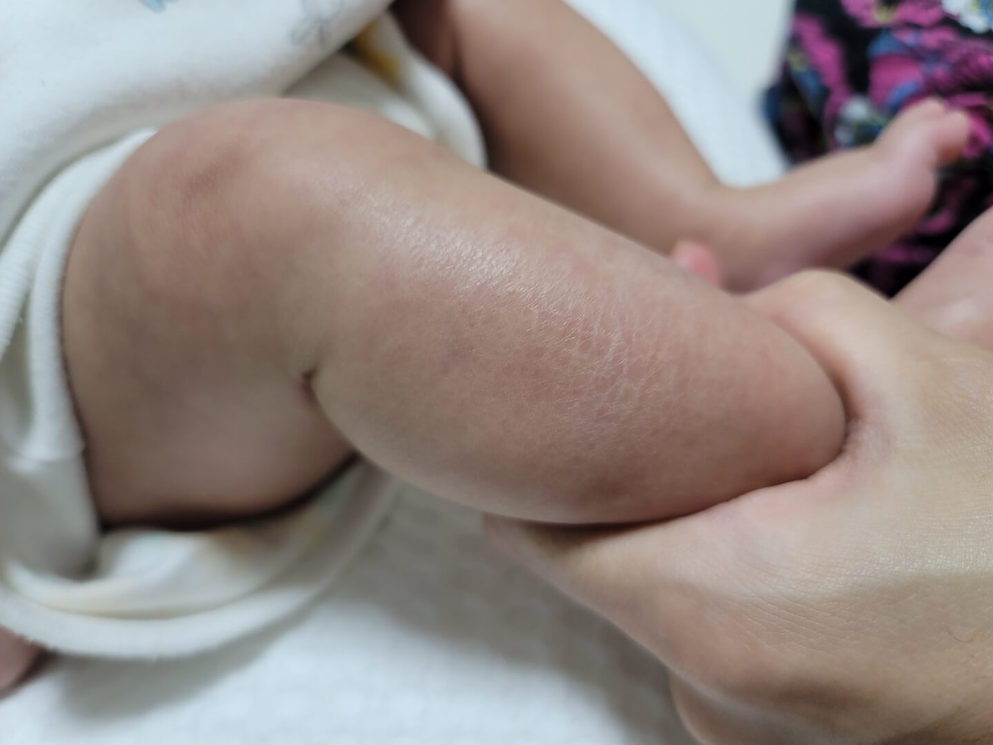 어린선 피부비늘증 현상