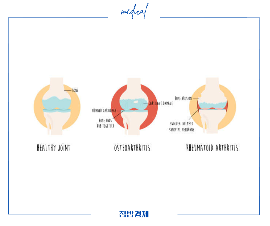 류마티스관절염