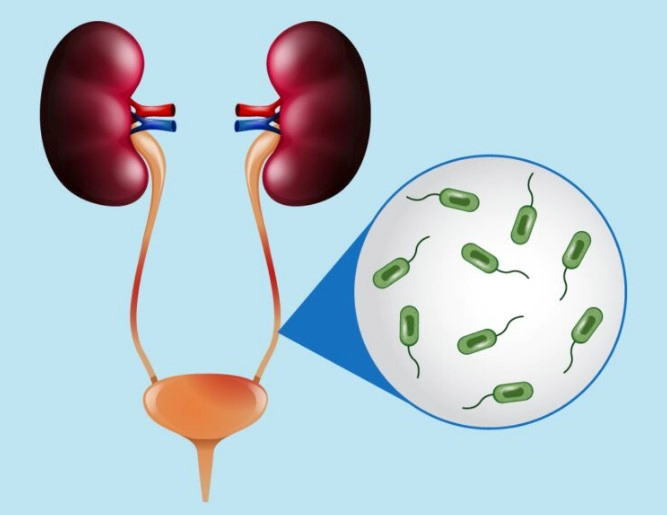 신우신염 증상 4가지 및 신우신염 치료기간과 방광염의 차이