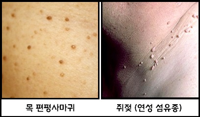 목편평사마귀-쥐젖(연성섬유종) 차이