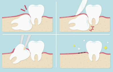 사랑니 발치후 식사 알아보기 커피&amp;#44; 흡연&amp;#44; 음주 정보