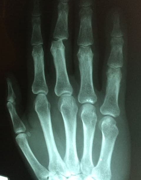 손가락-통증-치료