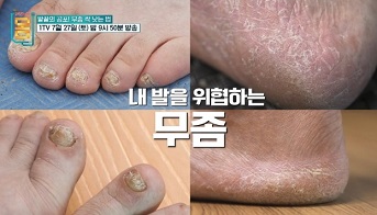 무좀