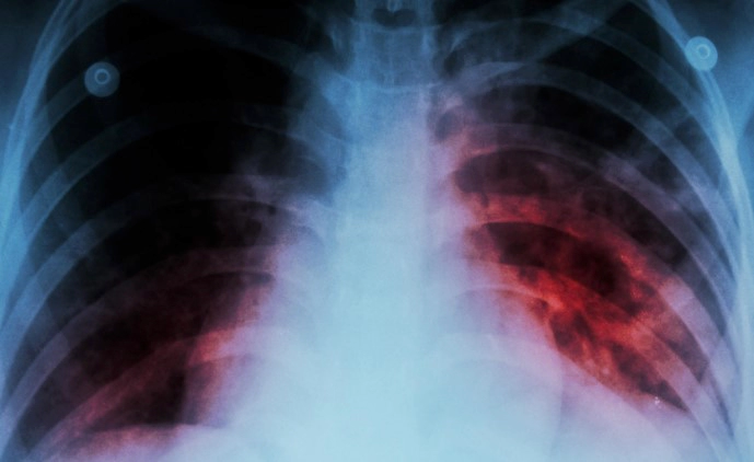 잠복결핵 양성 증상 및 검사 방법 보건소 병원 비용 정리 