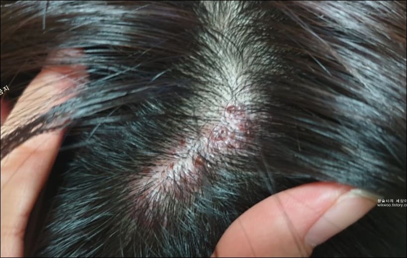 두피 대상포진