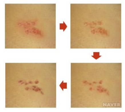 대상 포진 시기별 사진
