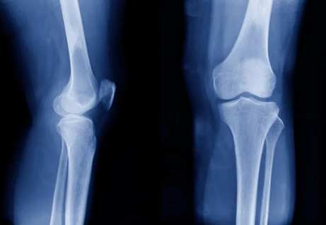 무릎관절통증 원인 효과적인 치료 방법