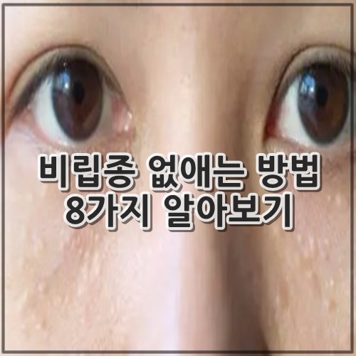 비립종 없애는 방법 8가지 알아보기