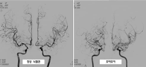 모야모야병 사진