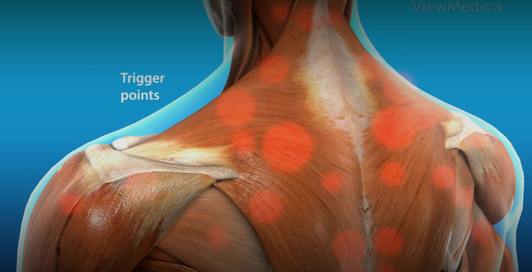 근막 통증 증후근과 트리거 포인트