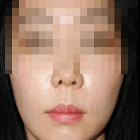 팔자주름 보톡스 맞은 후 사진