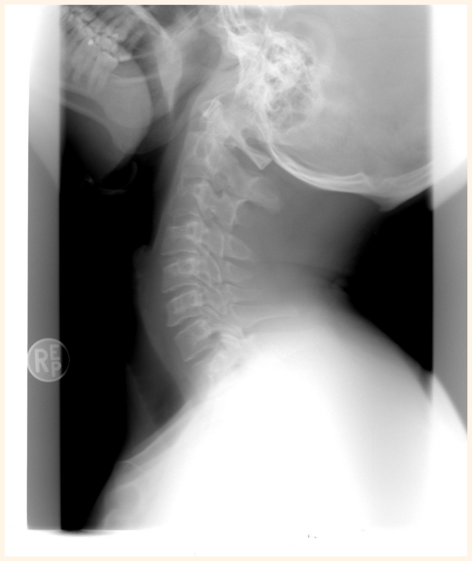 목디스크란? 목과 어깨 통증 원인은!
