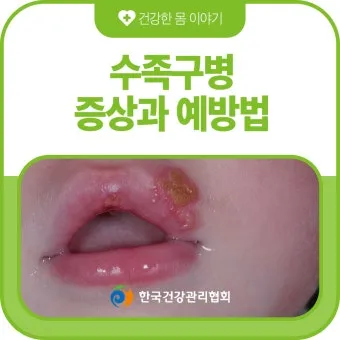 수족구병 증상과 예방 조치 방법 모음_17