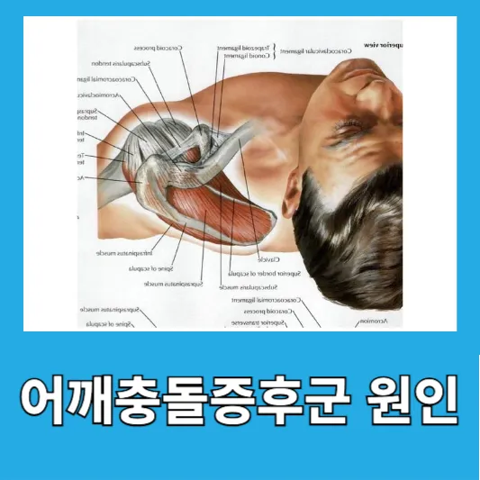 어깨충돌증후군 원인