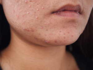 좁쌀 여드름 없애기