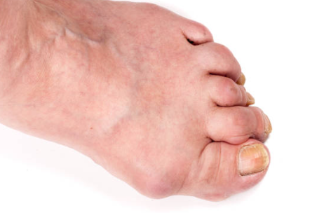 류마티스 관절염 말기