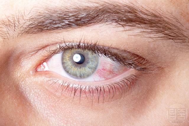 눈 따갑고 눈물 안구건조증 해결 눈뻑뻑함 이물감 눈건조증 원인