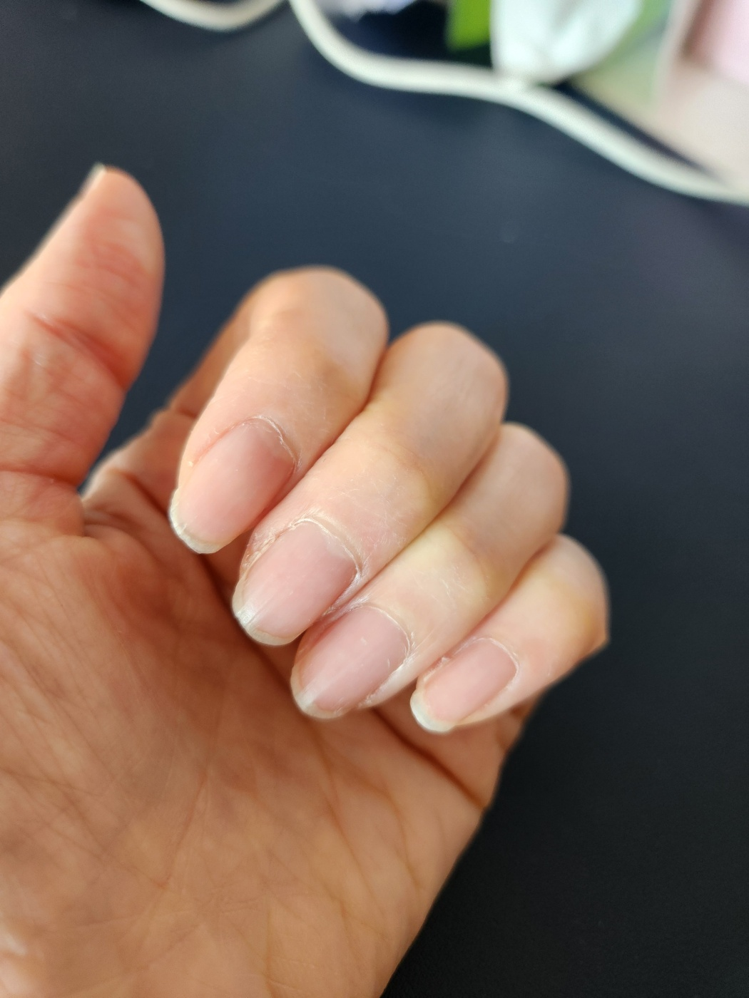 손톱에 흰점이 생기는 이유