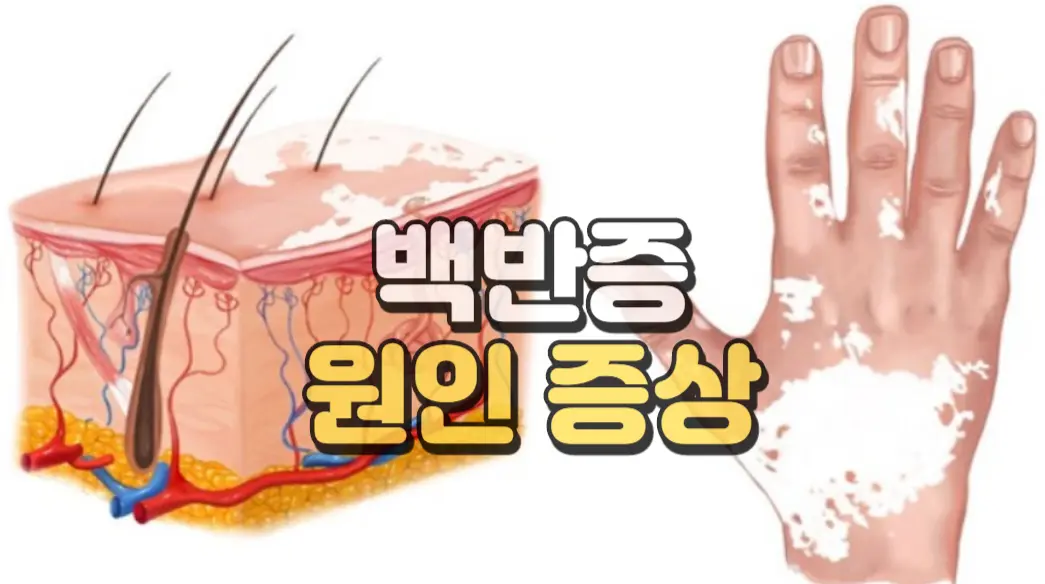 백반증 원인 증상