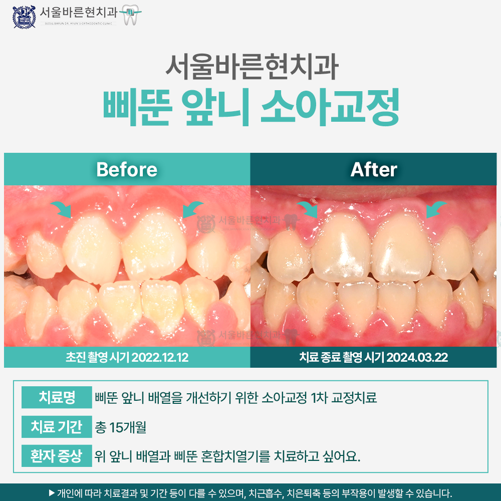 부산소아교정