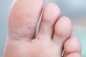 무좀의 주요 증상