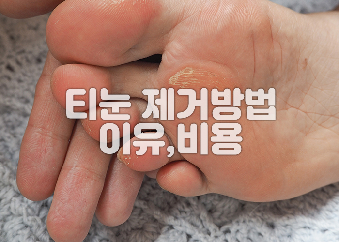 티눈이 생긴 발바닥 이미지