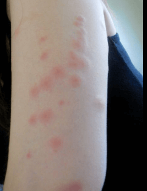 여행중빈대(베드버그)피하는법-빈대피하기수칙