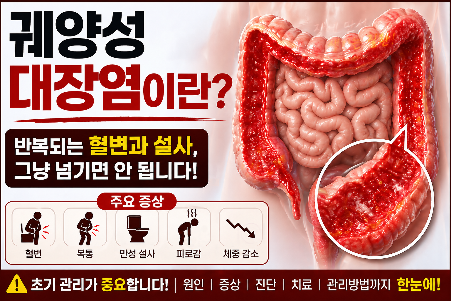 궤양성 대장염 초기 증상과 혈변, 설사, 복통을 설명하는 건강 정보 이미지