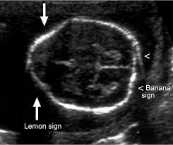 레몬사인 바나나사인
