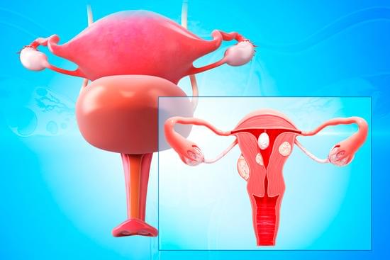 자궁 동맥 색전술 (UAE)에 대한 이해