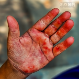 혈소판수치가 높으면