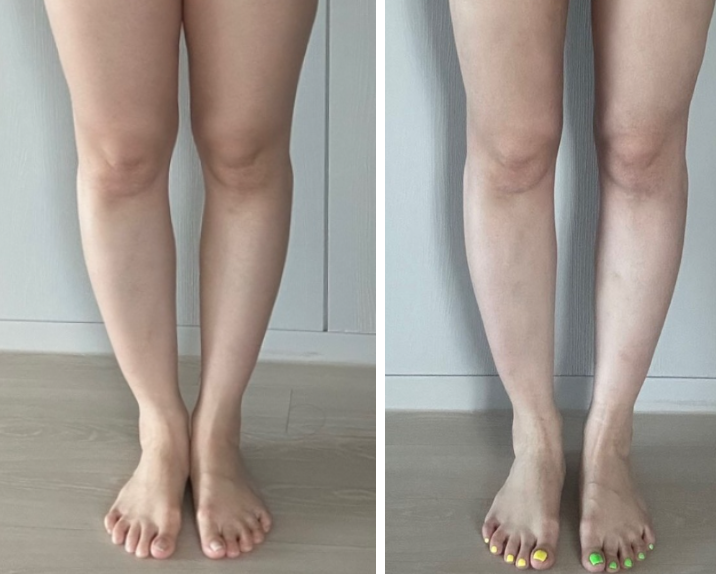 허벅지 지방흡입 후기