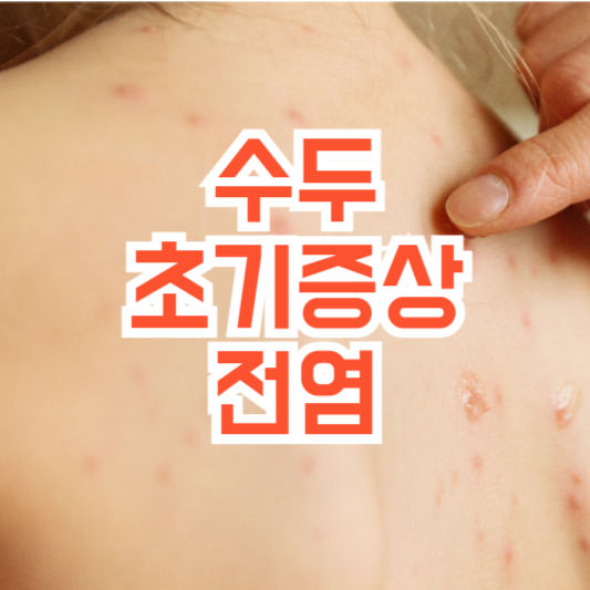 수두 초기증상, 우리아이도 전염될까!?