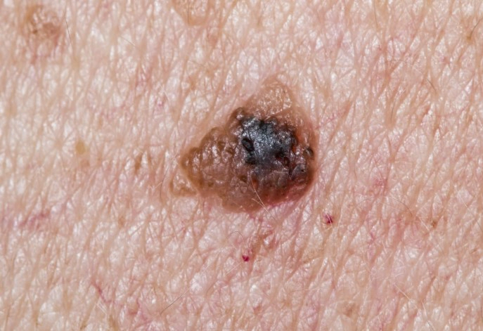 흑색종 점모양 피부암 수술사례