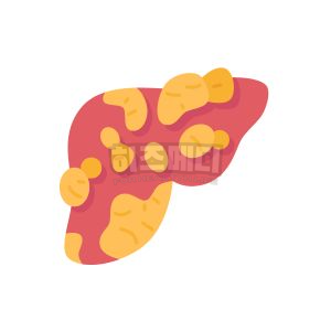 ALT수치가 높으면