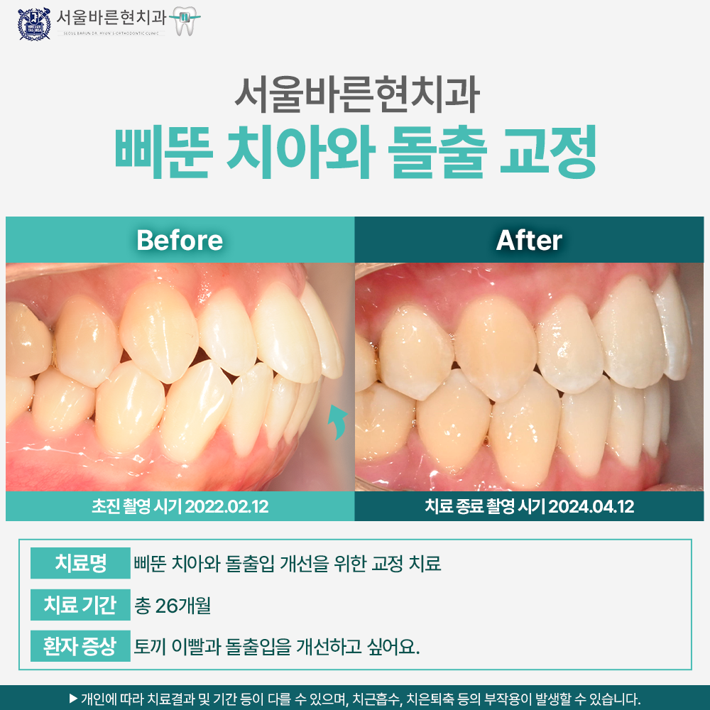 마린시티 돌출입교정