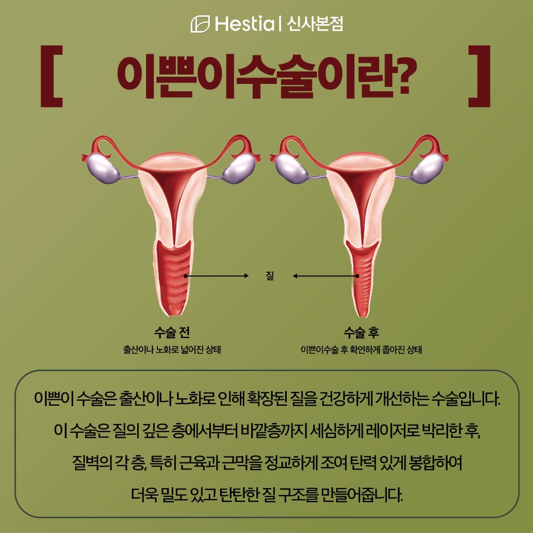 이쁜이수술이란?