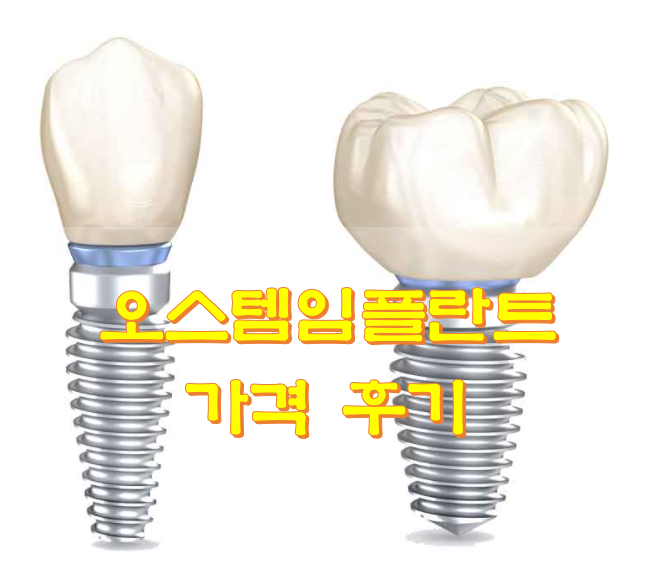 오스템 임플란트 가격