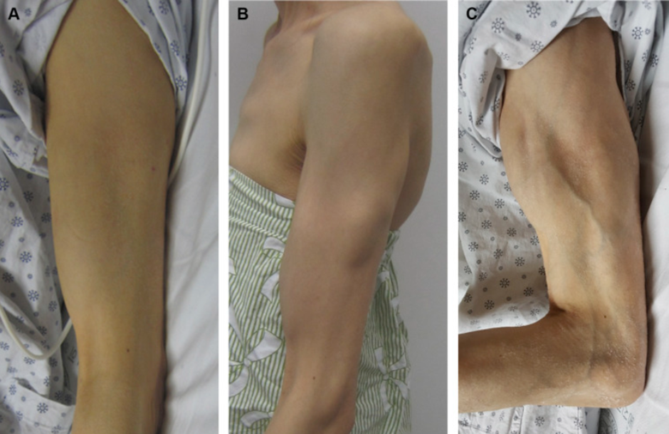 강직증후군을 가진 50대 중년 여성 환자의 팔뚝이 점점 강직됨